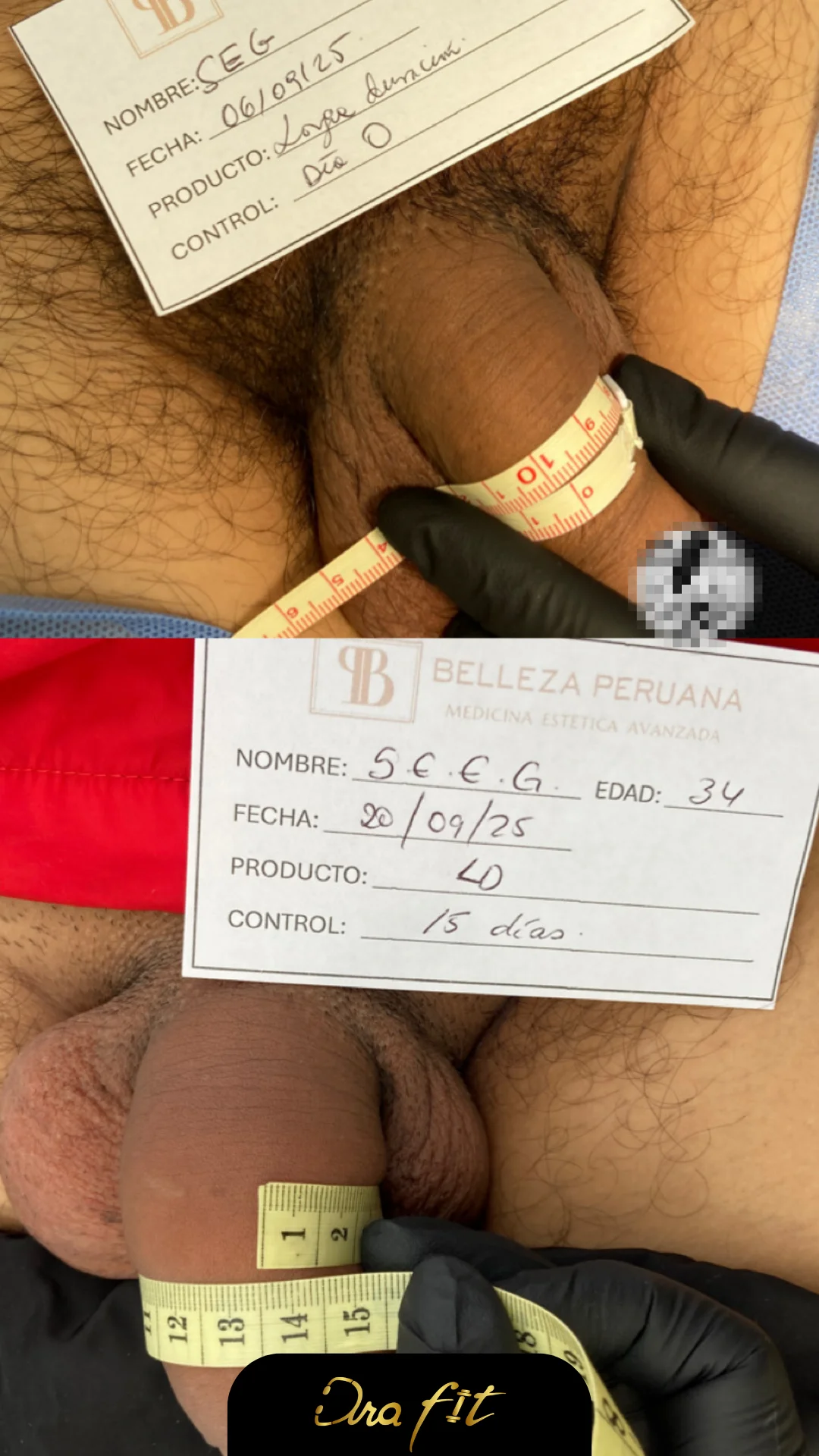 Engrosamiento peneano con ácido hialurónico — resultado en consulta de la Dra. Fit