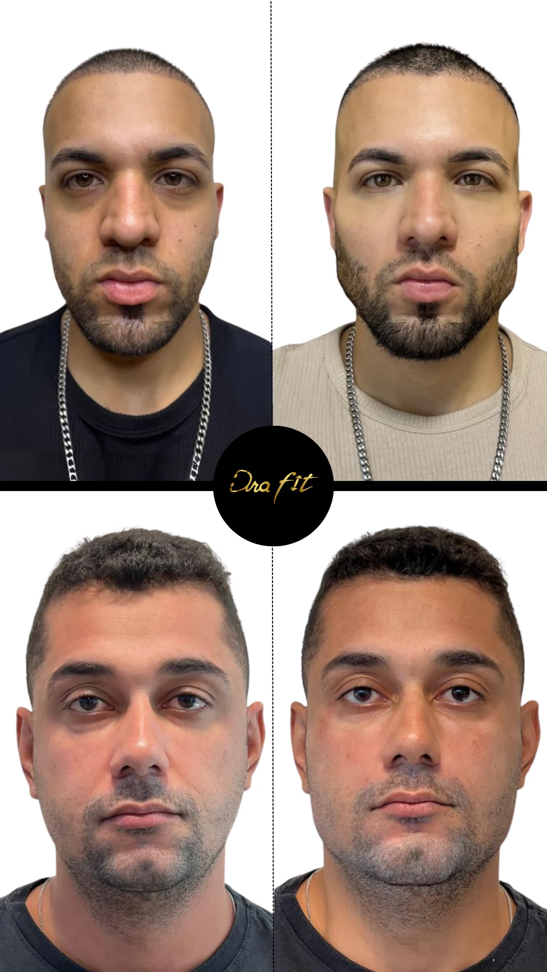 Masculinización facial — resultado antes y después
