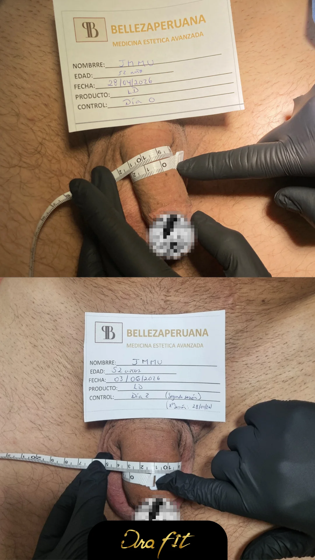 Engrosamiento peneano con ácido hialurónico — resultado en consulta de la Dra. Fit