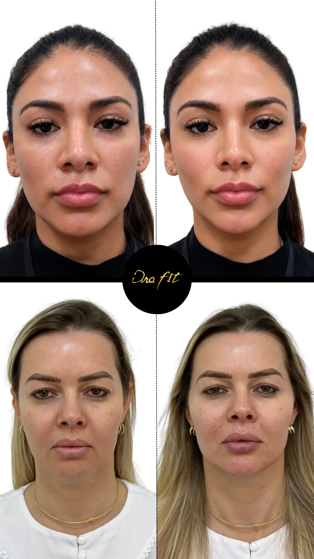 Feminización facial — resultado antes y después
