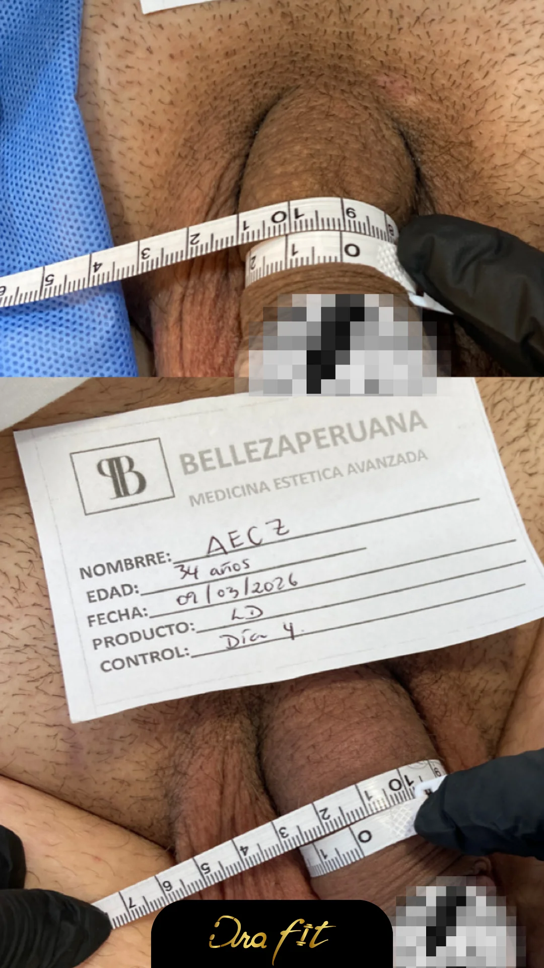 Engrosamiento peneano con ácido hialurónico — resultado en consulta de la Dra. Fit