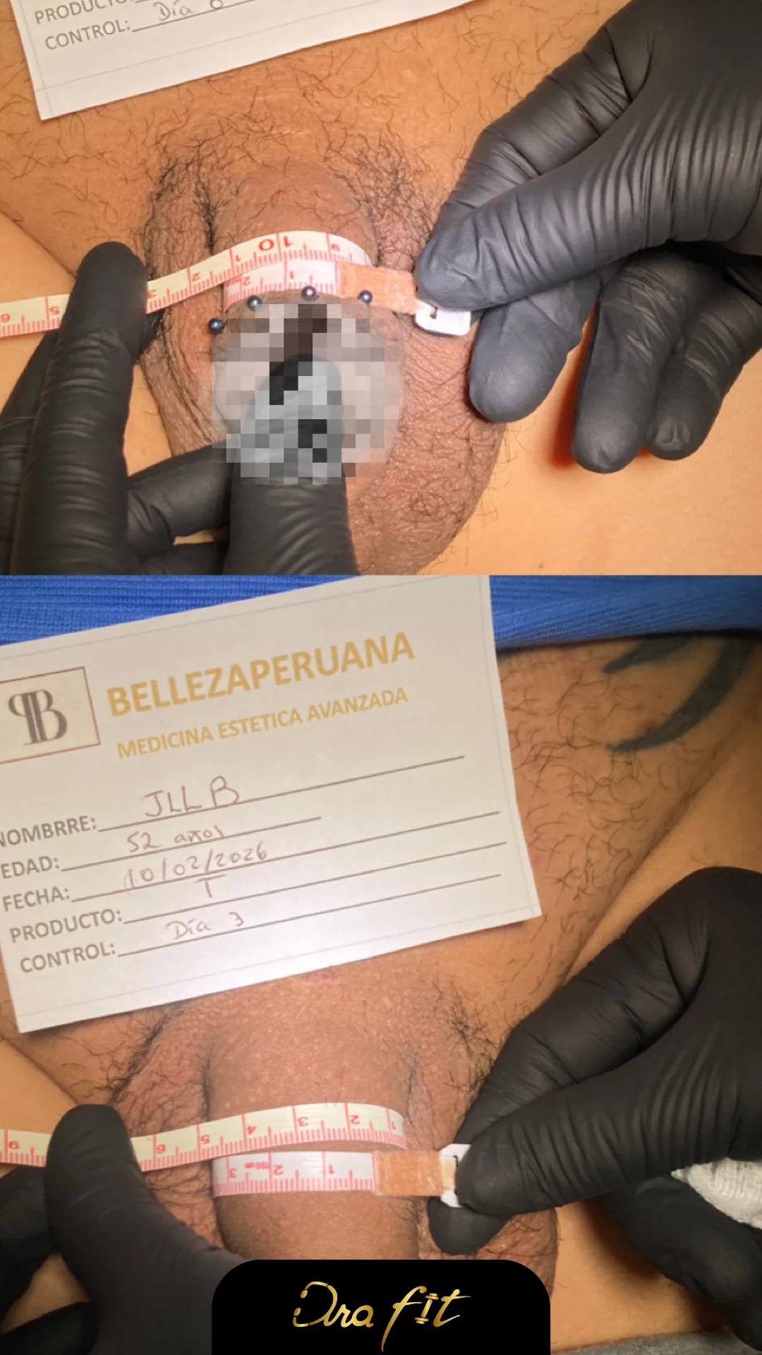 Engrosamiento peneano con ácido hialurónico — resultado en consulta de la Dra. Fit
