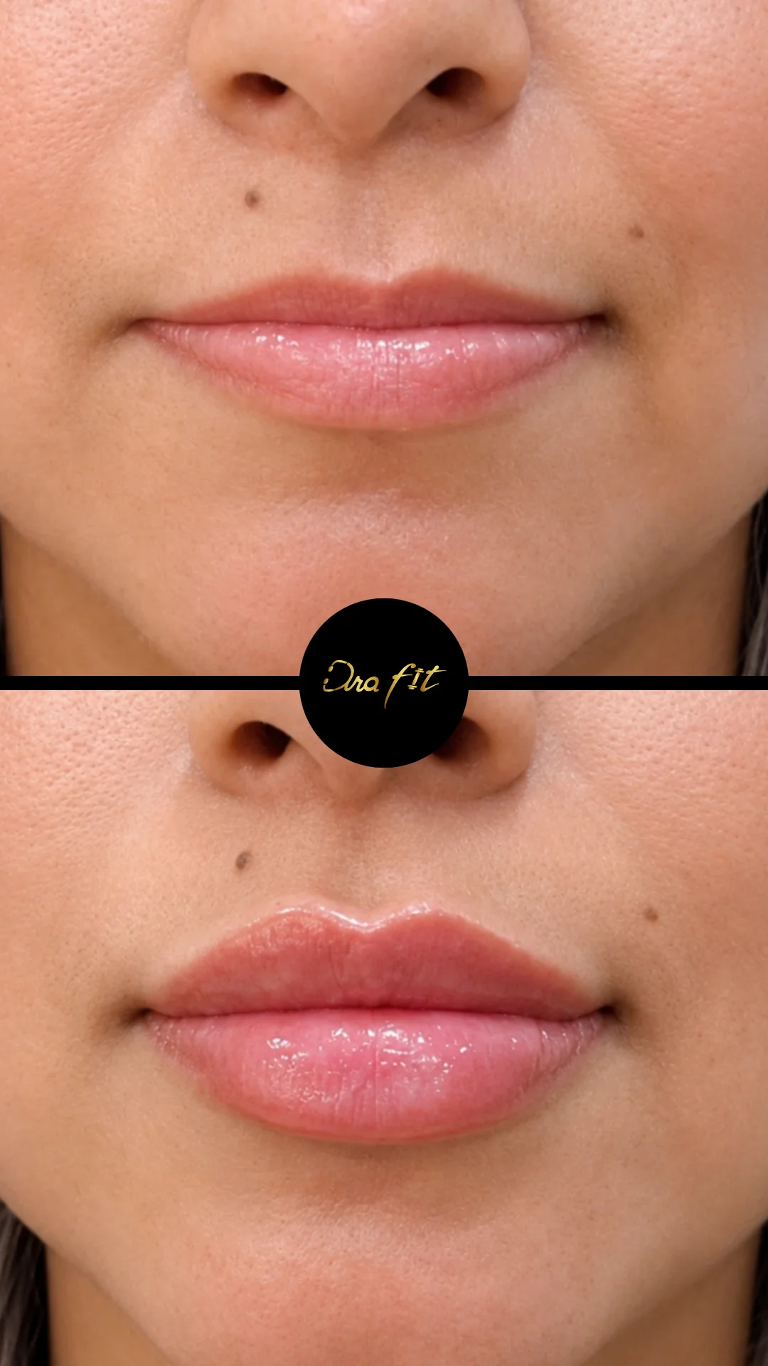 Escultura labial — resultado antes y después