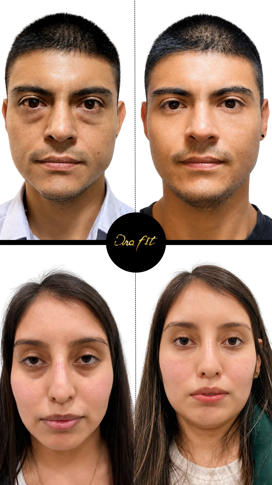 Ojeras — resultado antes y después