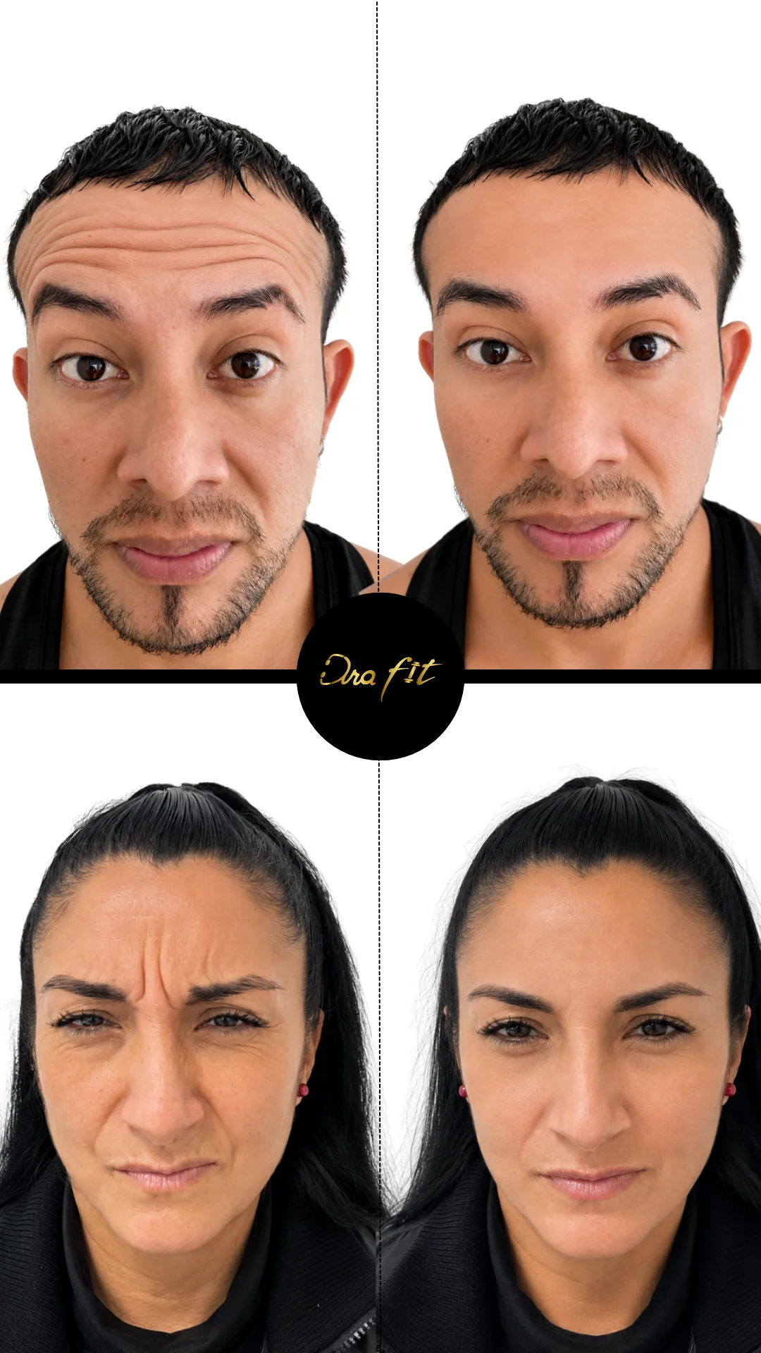 Toxina botulínica — resultado antes y después